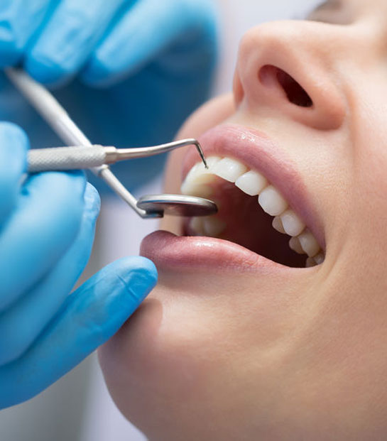 curetage-parodontal-clinique-dentaire-chantepoulet