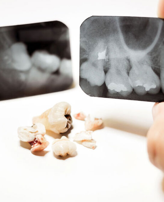 Procédure et coût de l'extraction des dents de sagesse - Dentakay