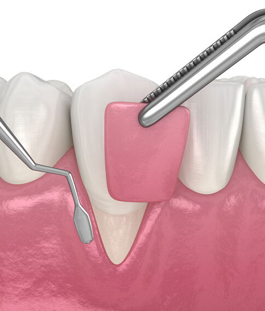 greffe-gingivale-clinique-dentaire-chantepoulet