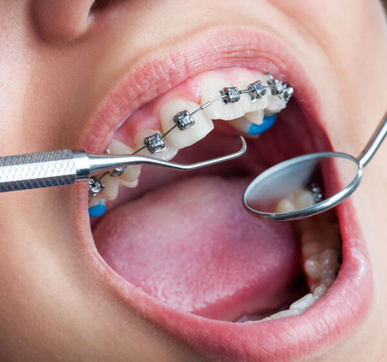 orthodontie-conventionnelle-clinique-dentaire-chantepoulet