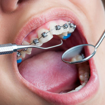 orthodontie-conventionnelle-clinique-dentaire-chantepoulet