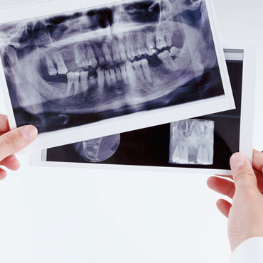 radiographie-numerique-clinique-dentaire-chantepoulet