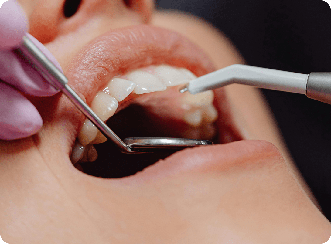 clinique-dentaire-chantepoulet-gbt-scaling-gbt-our-goal-your-healthy-smile