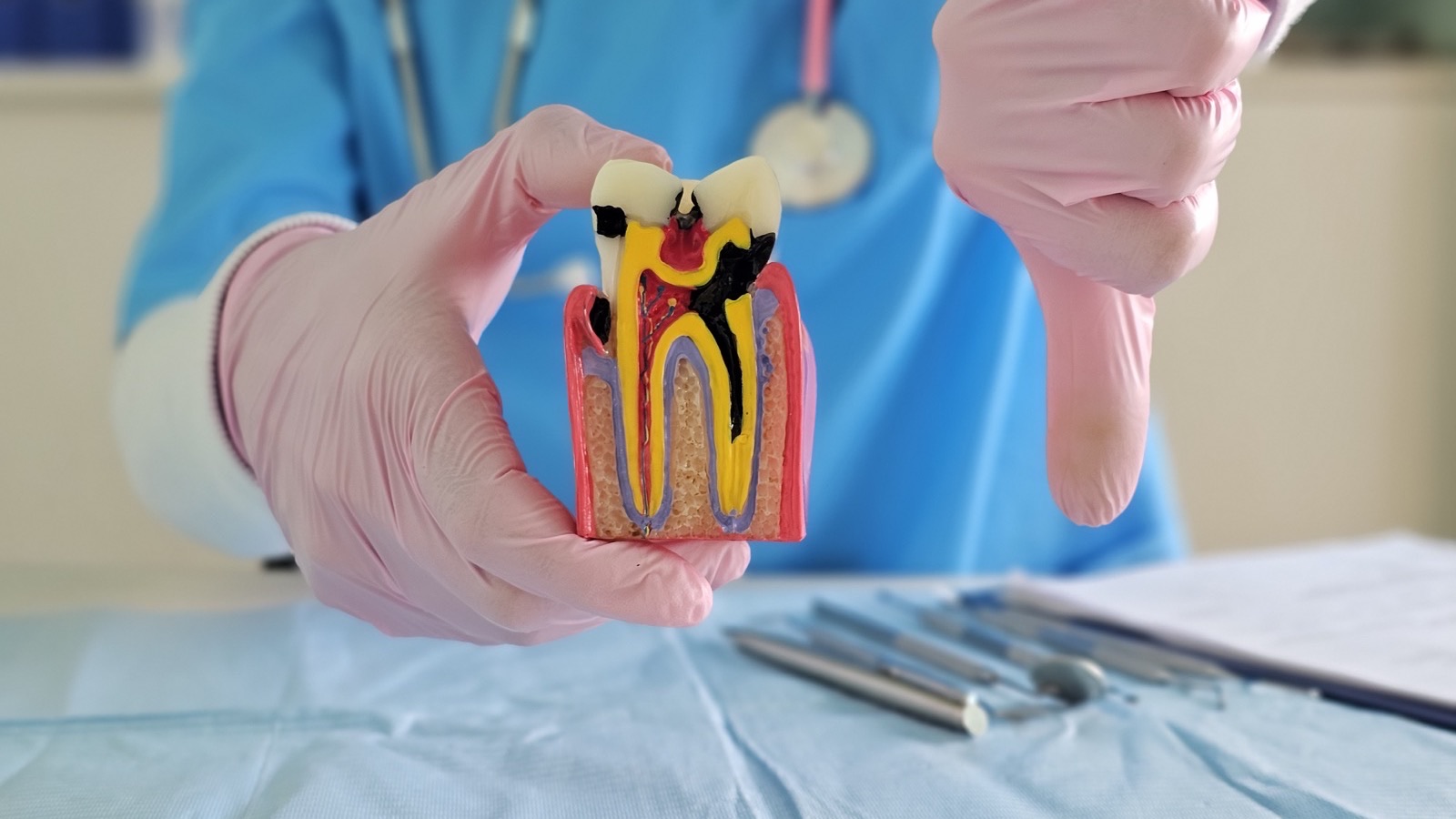 Dentiste montrant un modele de dent atteinte de carie en consultation