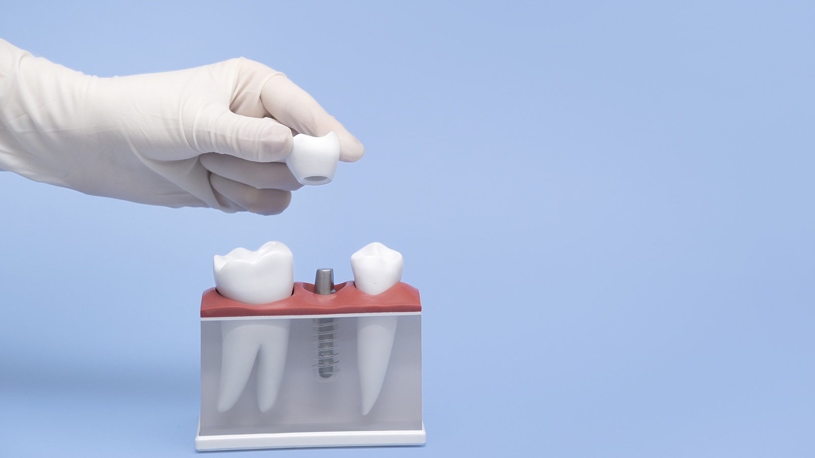 Modele d implant dentaire tenu en main