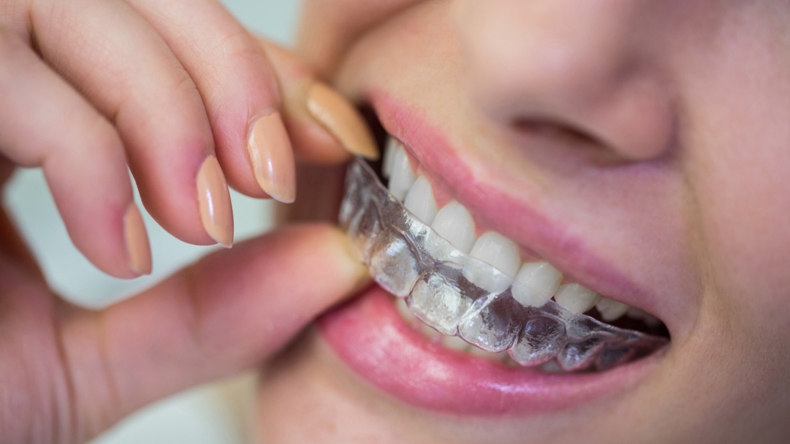 Patiente portant une gouttiere orthodontique transparente